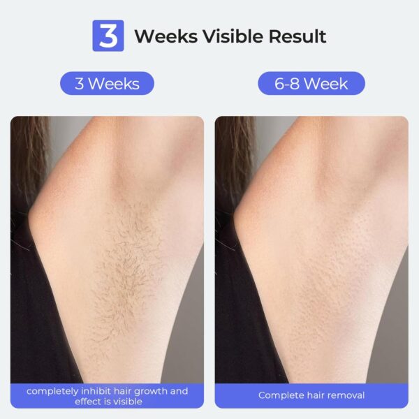 Hair Removal Device - Image 5